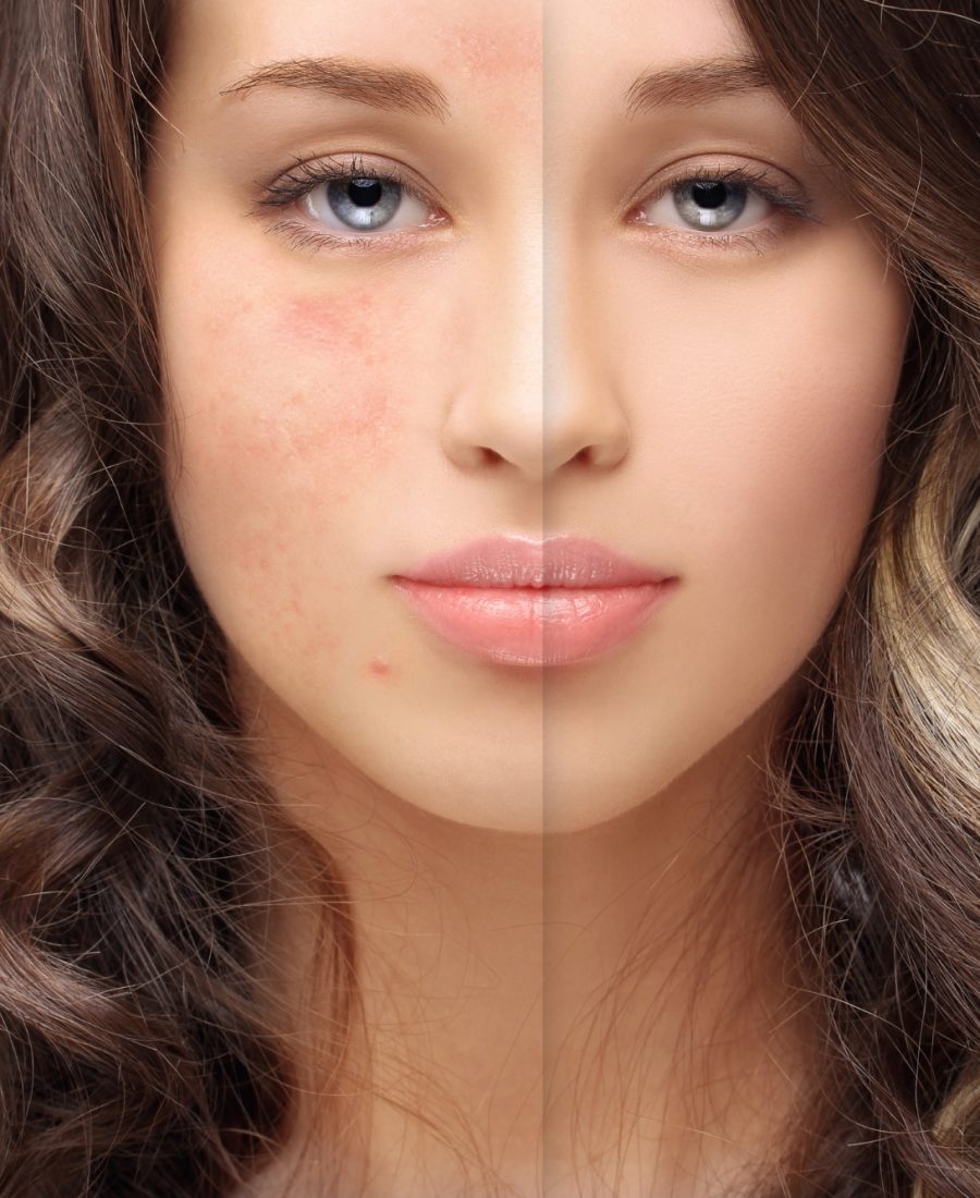 Acne & Acne Scars Treatment