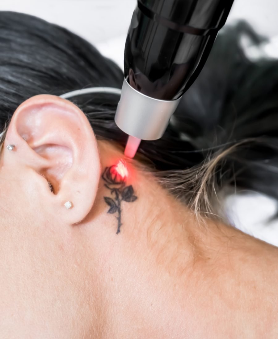 Tattoo Removal