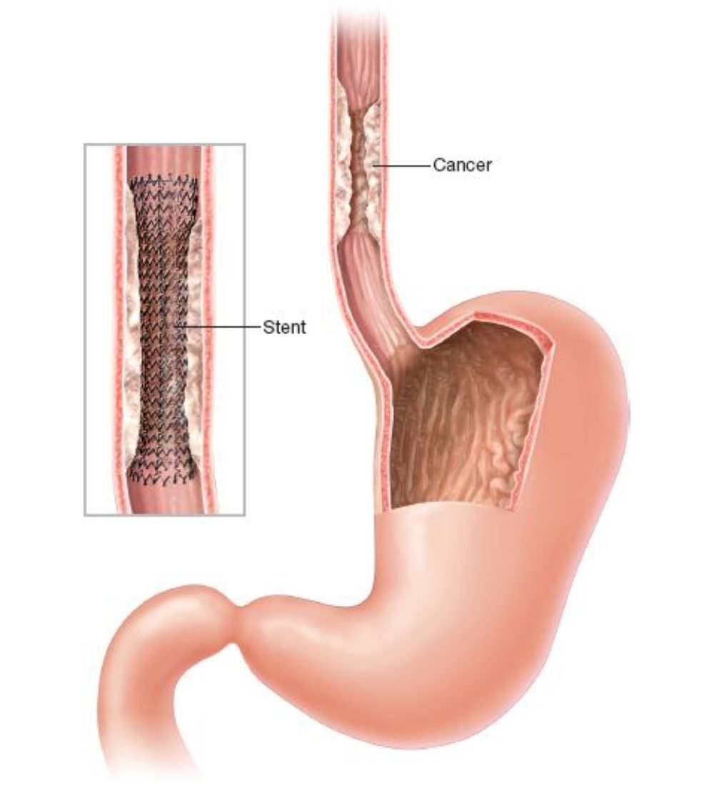 esophageal Stent